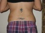 1 week after smart lipo - back